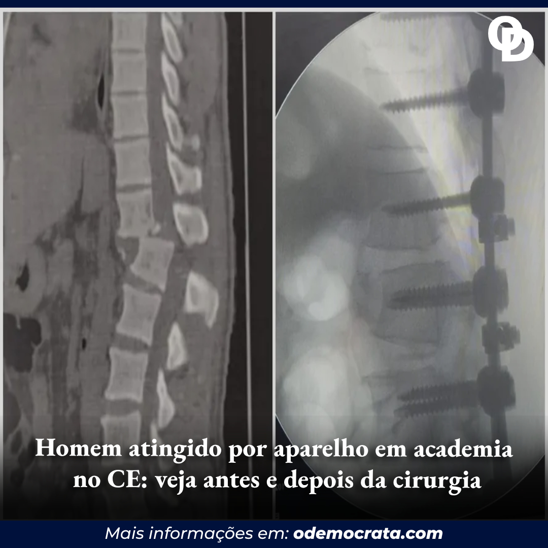 Tomografia mostra lesão na coluna de homem atingido por aparelho em academia  no Ceará, Cariri